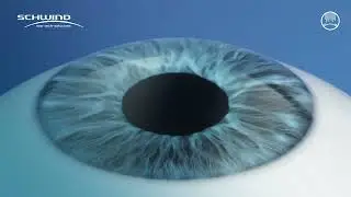 This Is How A SmartSurface Laser Eye Surgery Procedure Is Performed | Matrika Eye Center