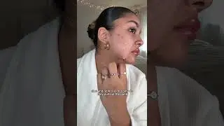 SATISFYING Pimple Patch Reveal 🤩