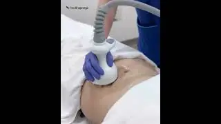Venus Legacy Body Contouring Singapore - Healthsprings Aesthetics Medispa