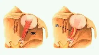 Clinical Anatomy of the Oculomotor (CNIII), Trochlear (CNIV), and Abducens (CNVI) Nerves (subtitled)