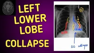 LEFT LOWER LOBE Collapse! How does it appear on chest xray ?