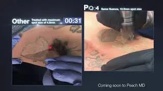 Coming Soon to Peach: PiQo4 - the best Laser Tattoo Removal