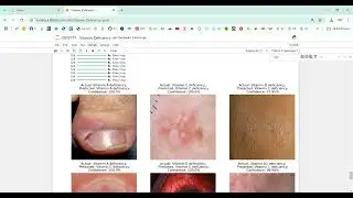 Vitamin Deficiency Detection Using Image Processing in Python Projects
