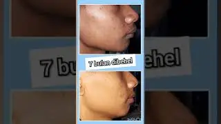 gigi super tonggos jadi rapi
