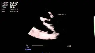 Right Ventricular Dysfunction   15 second cineloop After Intervention