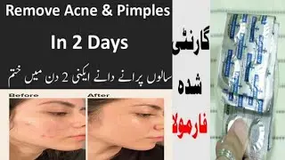 Best Treatment For Remove Pimple & Acne In 3 Days | Disprin Tablet For remove Acne at Home