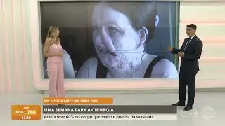Uma semana para cirurgia de Ariella que teve 60% do corpo queimado | Cotidiano | SCC Meio-Dia