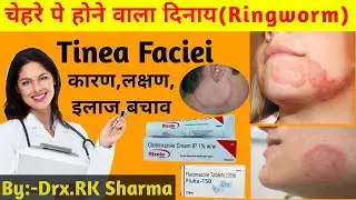 चेहरे पर होने वाले फंगल इन्फेक्शन  |ringworm infection treatment | how to remove ringworm from skin