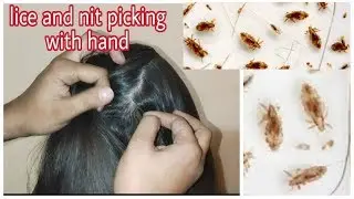 Real lice and nit picking with hand/ how to pick nits and lice