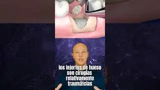 Los Injertos de Hueso funcionan as&iacute;