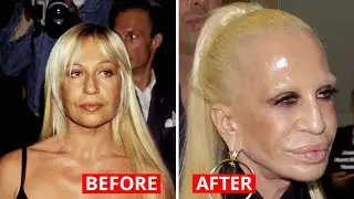 10 худших провалов пластических операций знаменитостей всех времен
