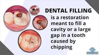 What is a Dental Filling? And How to properly take care of them