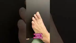 MINIMALLY INVASIVE FOOT SURGERY DOES EXIST! 💪🏼#shorts #bunionsurgery