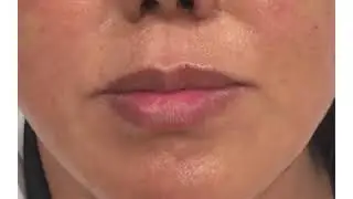 MINT / PDO Thread lift - Before After at the Beverly Hills Plaza Medi Spa 02