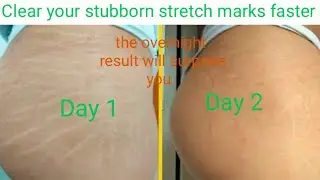The best stretchmarks remover home made scrub with ginger.(1)