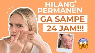 6 Skincare Hilangin Jerawat dan Bekasnya, Mulai 12 Ribuan