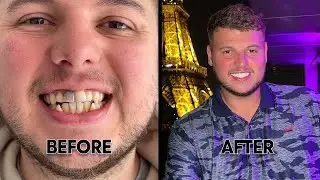 I GOT RID OF MY BLACK TOOTH!!🦷😱