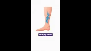 Can walking prevent varicose veins?