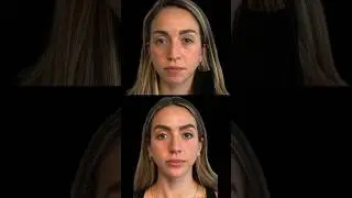 MUST SEE Incredible Non-Surgical Beauty Enhancement  #botox #attraction