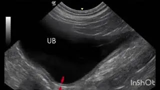 Bladder Wall Thickness on Ultrasound: What You Need to Know