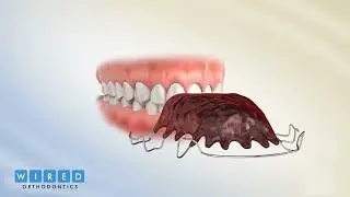 3D Animation of Hawley Retainer | Orthodontist Toronto