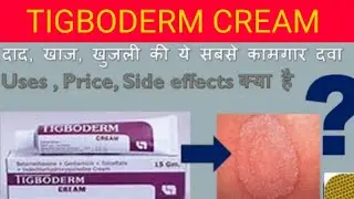 TIGBODERM CREAM की पूरी जानकारी | Uses, Price,Side - effects | Full Reviews in Hindi