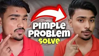 Why Do We Get Pimples Every Day? | Real Scientific Reason & Remedies Explained in hindi