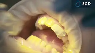 SCD - The Composite Injection Technique (F.I.T).