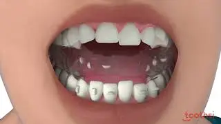Toothsi Aligner/ Teeth Alignment/ Teeth Straightening / Teeth Gap Treatment
