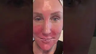 TCA PEEL HEALING DAY 3 #tcapeel #antiagingtreatments #antiagingsecrets
