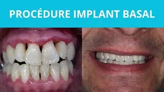Proc&eacute;dure Implant Basal