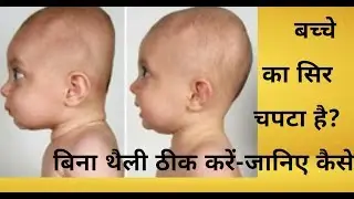 कैसे पता करें कि कहीं बच्चे का सिर चपटा तो नहीं हो गया -क्या करें(cure flat head in babies)