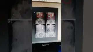 #bollywood #song #shortsviral  #pathaan #doctor #xray #anatomy xray kub kidney stone abnormal kub
