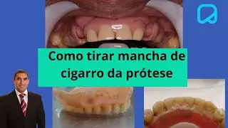 Como tirar mancha de cigarro da pr&oacute;tese ( dentadura) @dr.alexguedes