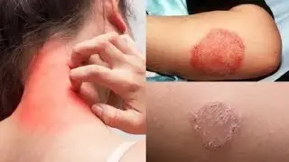 💥গরুয়া চুলকানি? একবার ব্যবহারেই মিলবে আরাম!