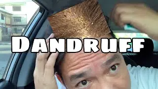 HOW TO TREAT DANDRUFF | NIZORAL SHAMPOO REVIEW