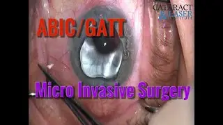 How to ABIC/GATT: Glaucoma EYE surgery ABIC + GATT