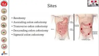 TIPS-ECHO Season 161 FCPN 21 : Session 10|Ostomy care |Sr Sheeba