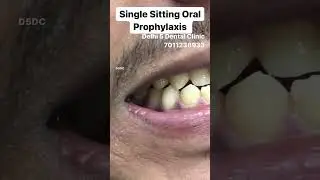 Teeth Cleaning | Scaling at DELHI 5 DENTAL CLINIC | Oral Prophylaxis | Link in description Shorts