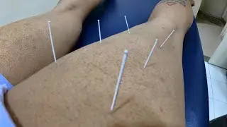 Dryneedling for hamstring muscles #runninginjury #musclerelease #marathonrunners #musclerecovery