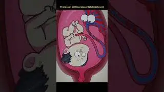 artificial placental detachment