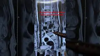 Tuberculosis of spine also called Potts spine #spine #spinesurgery #shorts #drgauravkhera #tbspine