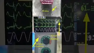 Temporary Pacemaker l TPI wirel Battery l Pacing seen on monitor #shorts