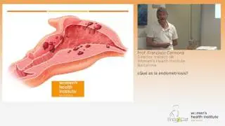 Dr. Francisco Carmona ¿Qué es la Endometriosis?
