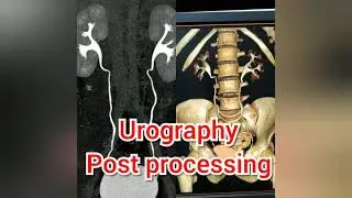 Urography post processing in hindi.Hindi me sikhe ct urography ke bare me