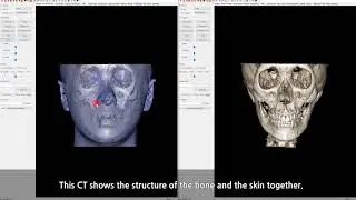 Is the protrusion on  a cheekbone  normal after cheekbone surgery? Cheekbone hump?
