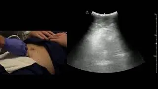 POCUS почек и мочевого пузыря, техника сканирования