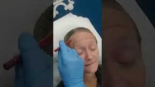 Botox Injection Mapping with Dr. Dahabra | Expert Tips for Perfect Symmetry & Placement #shorts