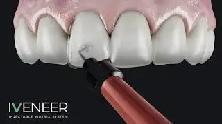 IVENEER - Injectable matrix system