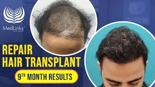 Results of Repair Hair Transplant After 9 Months | Best Hair Transplant Clinic in Delhi